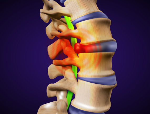 Decompression Therapy - Herniated Disc