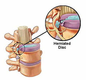 Decompression Therapy - Herniated Disc